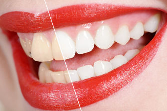 Bleaching - sanfte Aufhellung - weiße Zähne