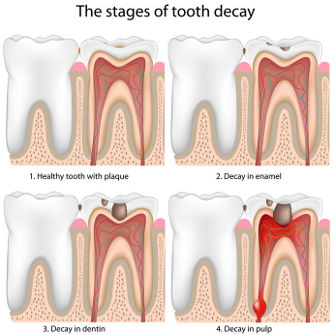 Endodontie: Entzündung der Pulpa